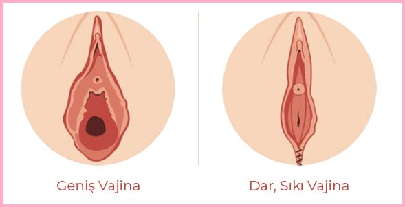 Vajinoplasti (Vajina Daraltma) Ameliyatı Nedir?